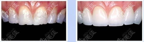 義獲嘉瓷貼面效果圖