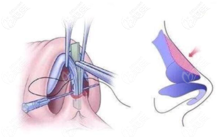 燕尾榫隆鼻示意圖 燕尾榫隆鼻示意圖