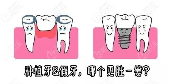 種植牙和假牙的對比