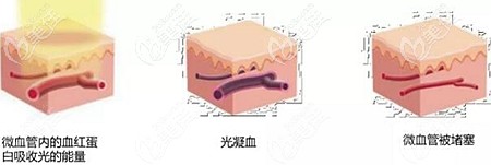 595染料激光去紅血絲的原理 595染料激光去紅血絲的原理