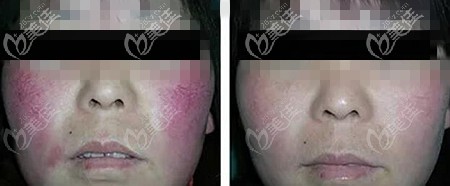 染料激光去紅血絲2次后的效果對比 染料激光去紅血絲2次后的效果對比