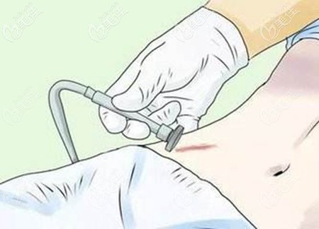 激光去色素疤痕