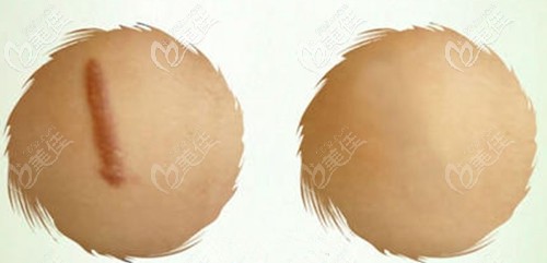 增生疤痕需要手術(shù)切除