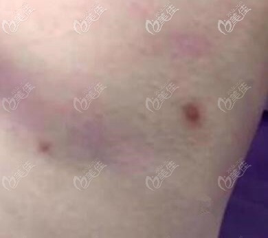 吸脂術(shù)后針眼發(fā)黑怎么治療