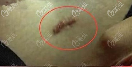 吸脂術(shù)后疤痕增生