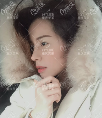 沒想到我用特價在重慶美萊做的肋骨鼻綜合效果沒打折！