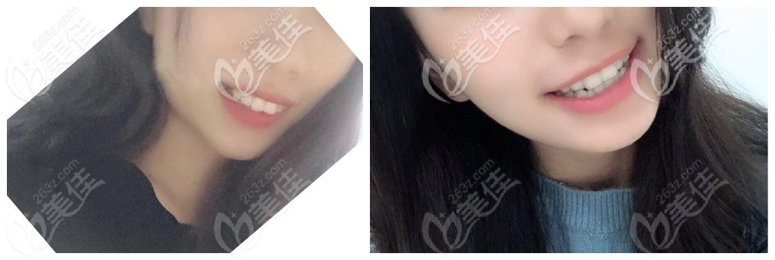 寧波壹加壹正雅隱形矯正實例