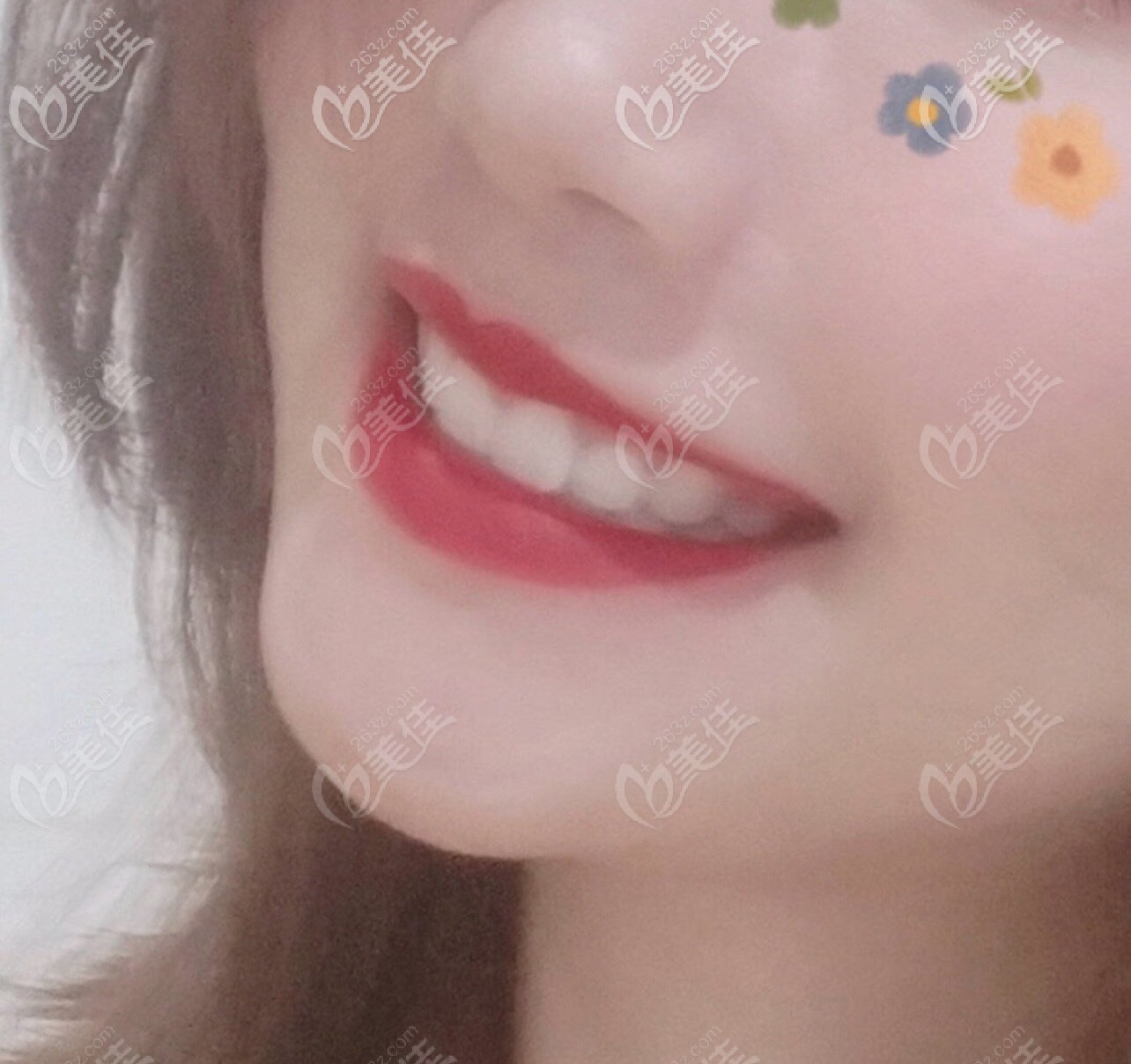 寧波壹加壹隱適美隱形矯正實例