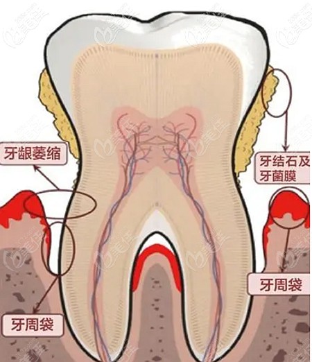 牙周袋的所在位置