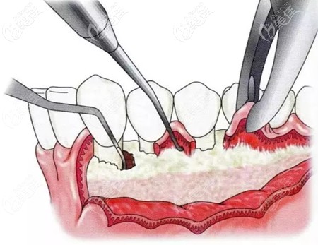 牙周翻瓣手術(shù)的原理