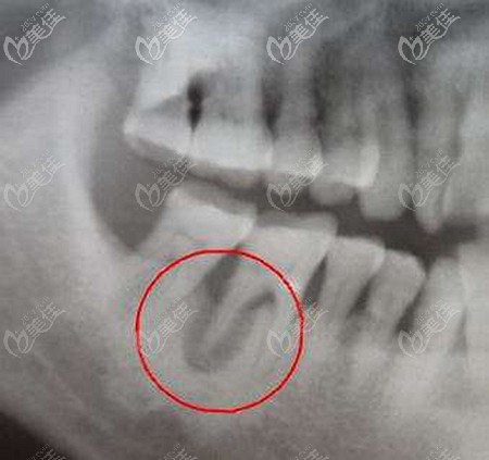 牙槽骨吸收?qǐng)D片