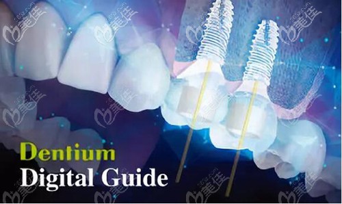 登騰種植體優(yōu)勢
