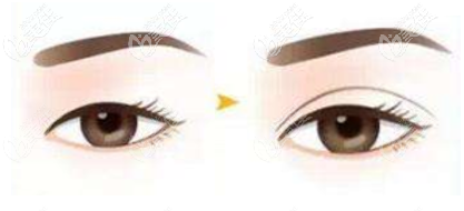 董國強醫(yī)生切開雙眼皮效果示意圖 董國強醫(yī)生切開雙眼皮效果示意圖