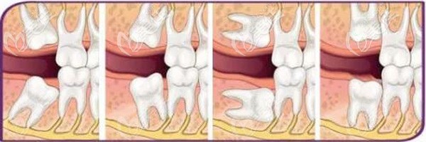 智齒不同的生長(zhǎng)方式