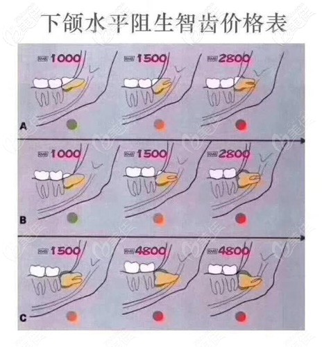 水平阻生智齒的參考價(jià)格