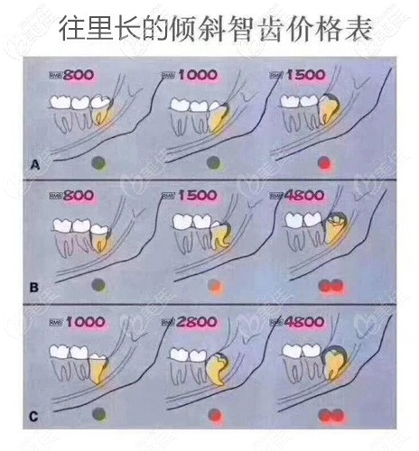 往門牙方向相反長(zhǎng)的傾斜智齒參考價(jià)格