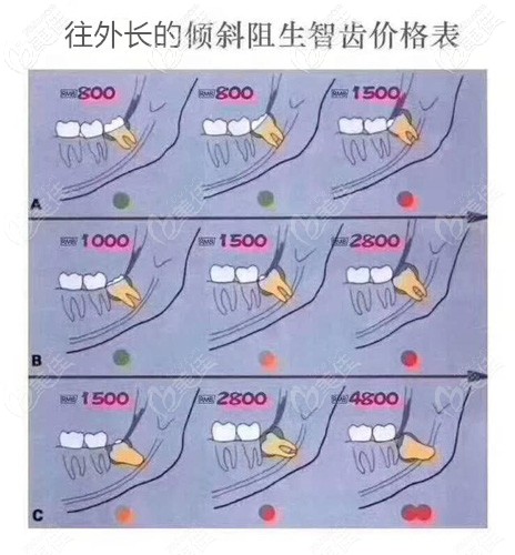 往門牙方向長(zhǎng)的傾斜智齒參考價(jià)格