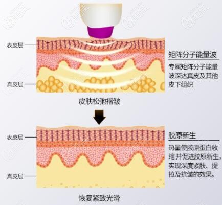 熱瑪吉治療皮膚過程示意圖