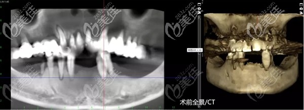 謝大叔術(shù)前口腔CT 謝大叔術(shù)前口腔CT