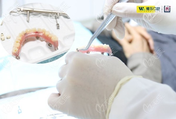 謝大叔臨時牙冠 謝大叔臨時牙冠