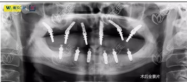 泉州種植牙哪里比較好？看下60歲大叔在泉州維樂做即刻負重全口種植一天就能吃蘋果
