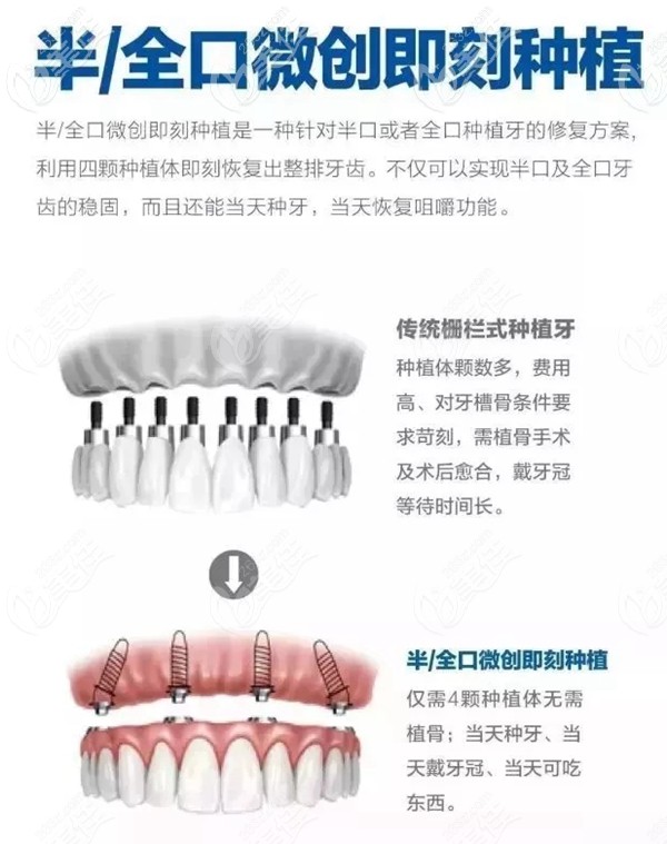 全口即刻種植和普通種植的優(yōu)勢 全口即刻種植和普通種植的優(yōu)勢