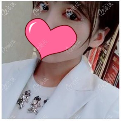 雙眼皮術(shù)后7天 雙眼皮術(shù)后7天