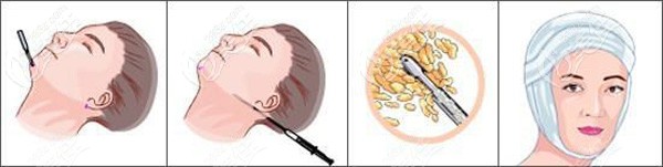 面部吸脂的原理
