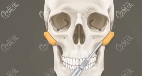 顴骨顴弓示意圖 顴骨顴弓示意圖