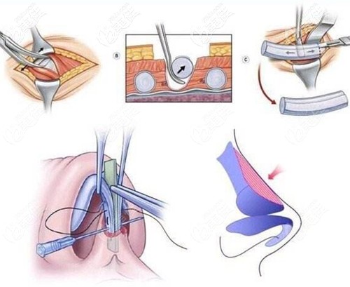 肋軟骨隆鼻的過程
