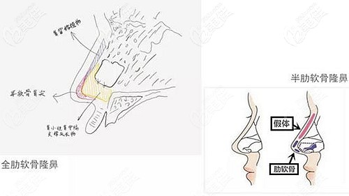 全肋軟骨隆鼻和半肋軟骨隆鼻