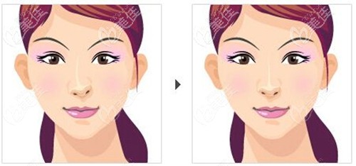 肋軟骨隆鼻術(shù)后出現(xiàn)變形怎么辦