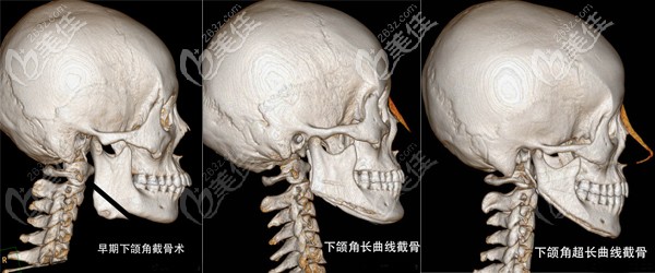 下頜角截骨手術(shù)的演變 下頜角截骨手術(shù)的演變
