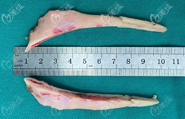 李運峰下頜角超長曲線截骨 李運峰下頜角超長曲線截骨