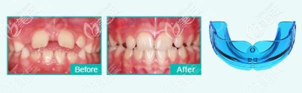 五洲麥芽口腔兒童牙齒矯正案例效果圖