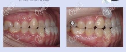 地包天戴隱形牙套矯正前后效果對(duì)比