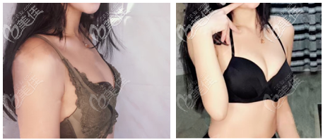 我找韋元強(qiáng)做的脂肪豐胸案例效果 我找韋元強(qiáng)做的脂肪豐胸案例效果