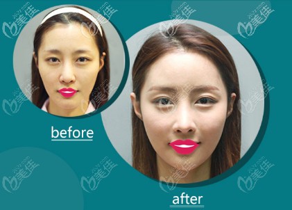 張寶成醫(yī)生做埋線提升案例