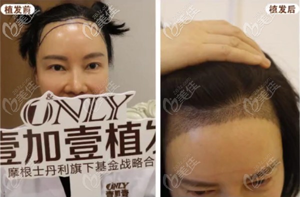 武漢壹加壹發(fā)際線種植案例效果