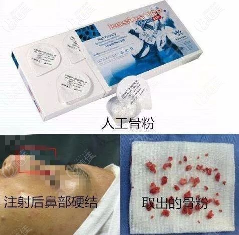 國內(nèi)明令禁止骨粉作為注射隆鼻材料