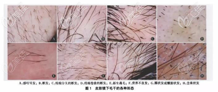 植發(fā)前檢測(cè)哪些項(xiàng)目？