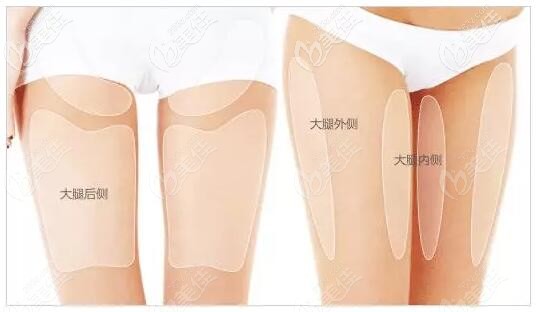大腿環(huán)吸抽脂的部位