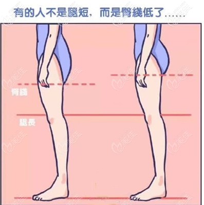 大腿抽脂包括臀線和臀部?jī)蓚?cè)