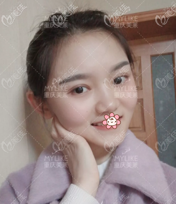 重慶美萊7mm全切平行型雙眼皮3個月圖片
