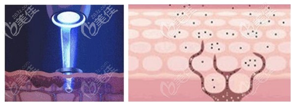 科醫(yī)能整形祛斑原理 科醫(yī)能整形祛斑原理