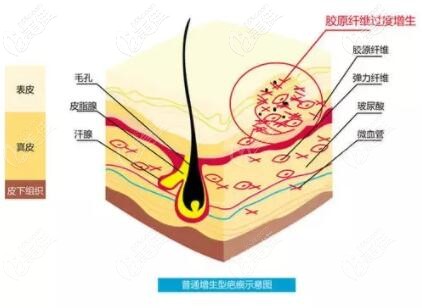 普通增生型疤痕示意圖