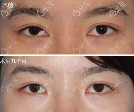 外折平行改內(nèi)折扇形案例