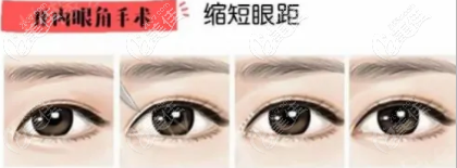 開內眼角的作用 開內眼角的作用