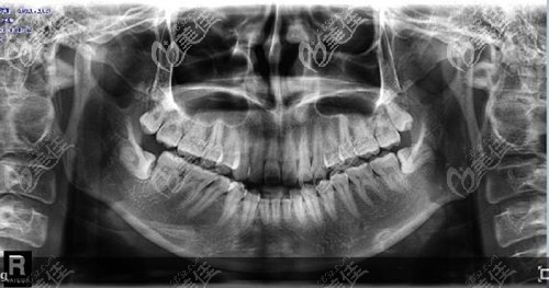 什么是橫生智齒