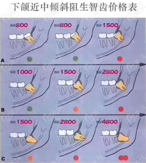 下頜近中傾斜阻生智齒價(jià)格表